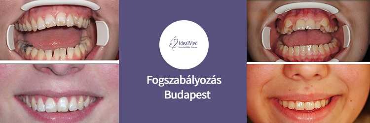 fogszabályozás Budapest árak