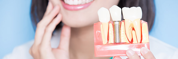 fogbeültetés menete implantátum