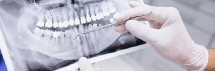 fogászati implantátum