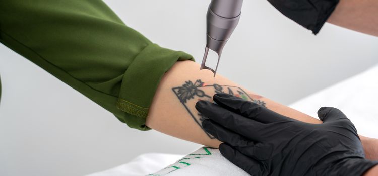tetoválás eltüntetése lézerrel