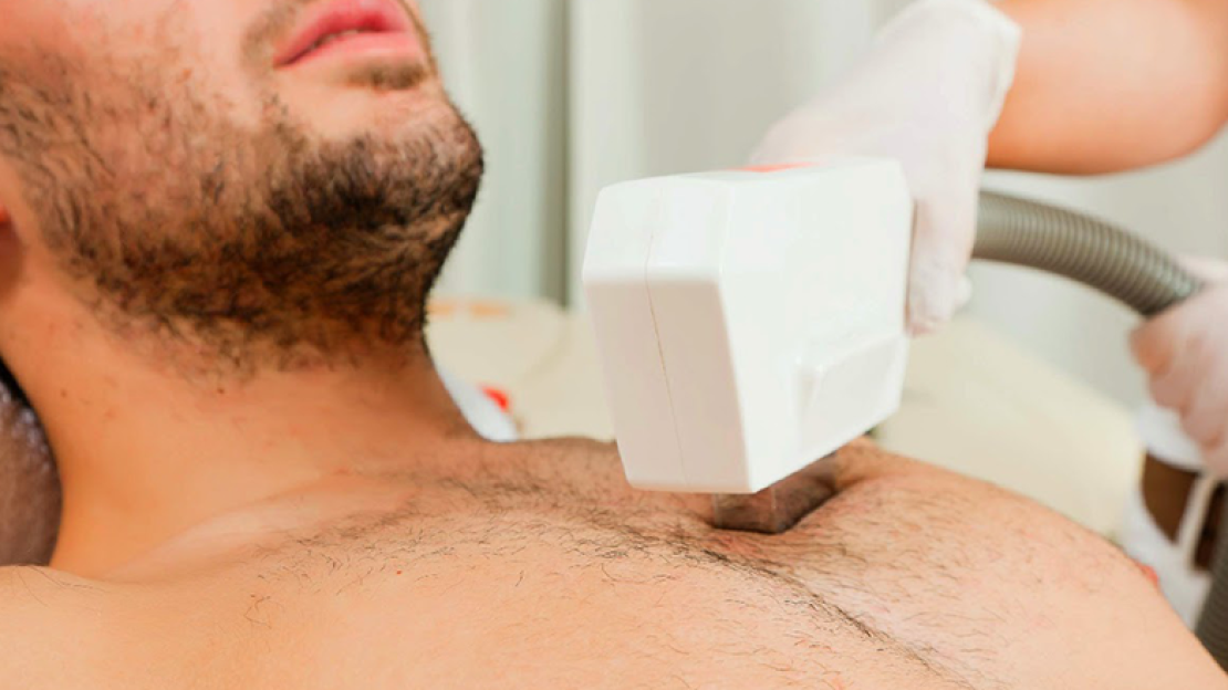 Férfi szőrtelenítés lézerrel