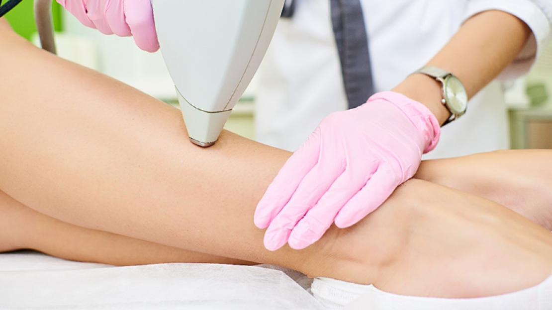 Lézeres szőrtelenítés ára