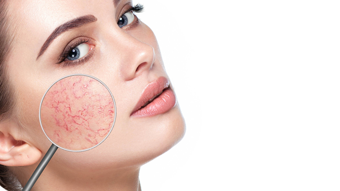 Rosacea kezelés – hogyan lehet az arc ereinek kitágulását, gyulladását enyhíteni?