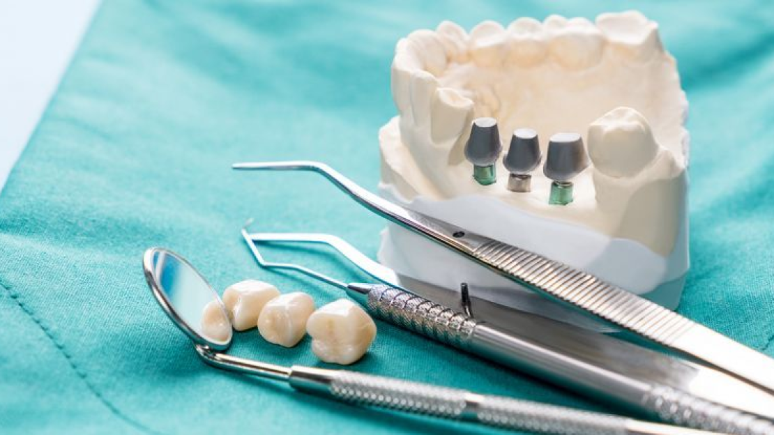 Fog implantátum, a tökéletes hosszútávú megoldás