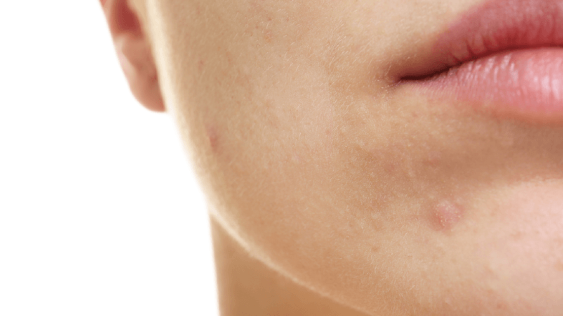 Számolj le végleg a bőrproblémákkal!