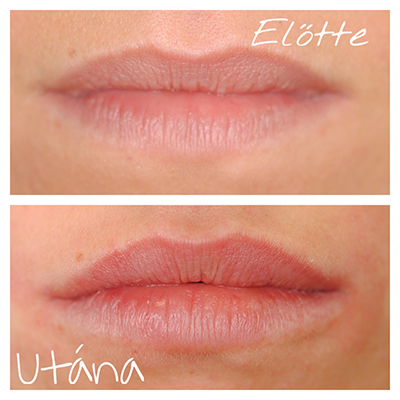 ajakfeltöltés Budapest referencia