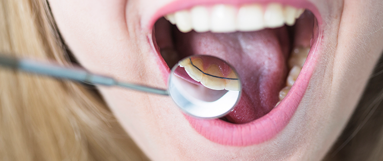 láthatatlan fogszabályozó kiváló hatékonysággal