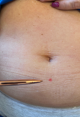 Hormon derm pont Dermal piercing