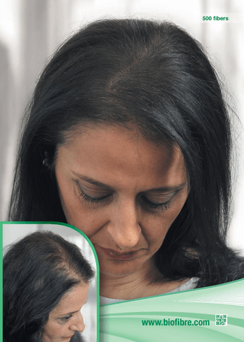 Hajbeültetés kezelés női hajhullás ellen