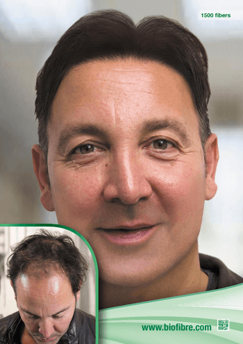 Hajbeültetés a kopaszság ellen