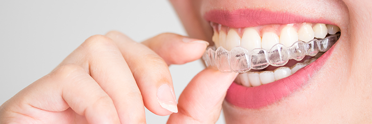 láthatatlan fogszabályzó kellemetlenségek nélkül