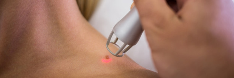 Lézeres anyajegy eltávolítás heg nélkül